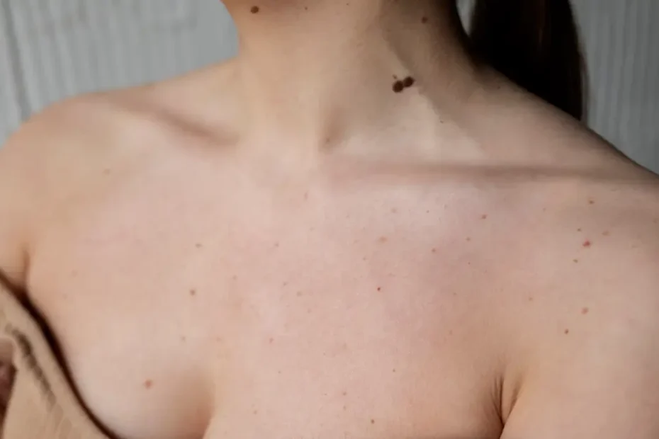 Descubra o que é essa mancha escura na pele diabetes, o que ela podem revelar sobre a diabetes